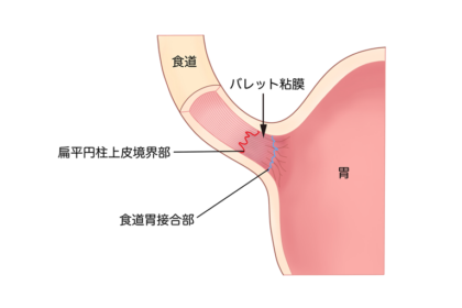 バレット食道とは