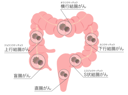 大腸がんとは
