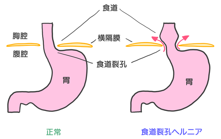 食道裂孔ヘルニアとは