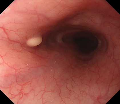 食道粘膜下腫瘍の症例画像
