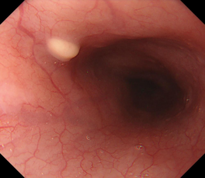 食道粘膜下腫瘍の症例画像