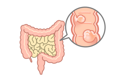大腸ポリープとは