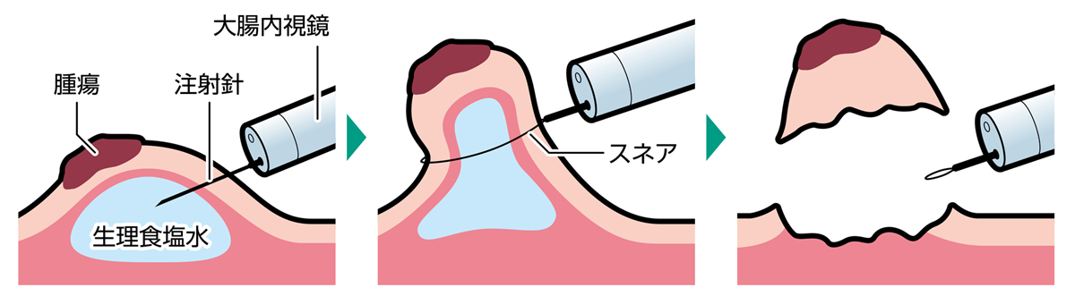 内視鏡的粘膜切除術（EMR）